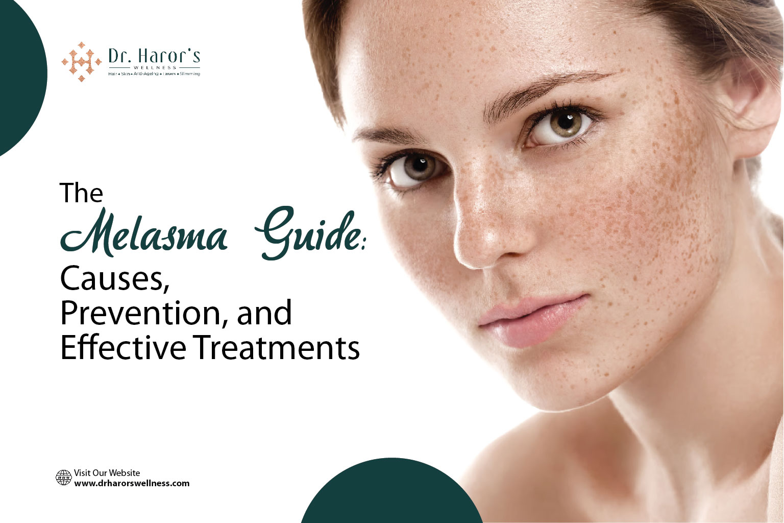 melasma-1-1782984995.jpg