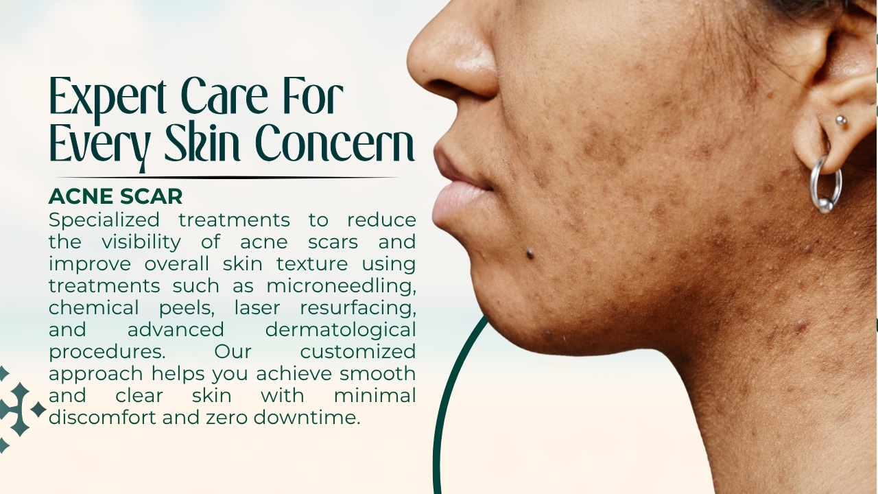 acne-scar-1783411596.jpg