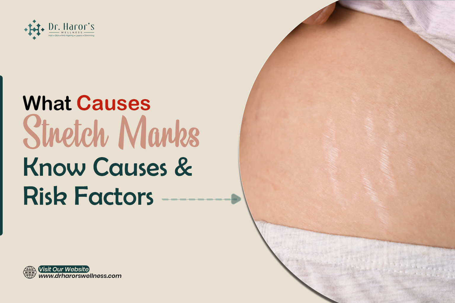 stretch-marks-1-1783599116.jpg